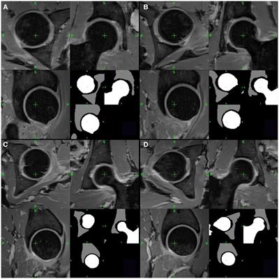 A radiomics approach to the diagnosis of femoroacetabular impingement
